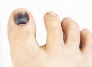 Почему чернеют и темнеют ногти на руках и ногах у женщин и мужчин: причины и лечение